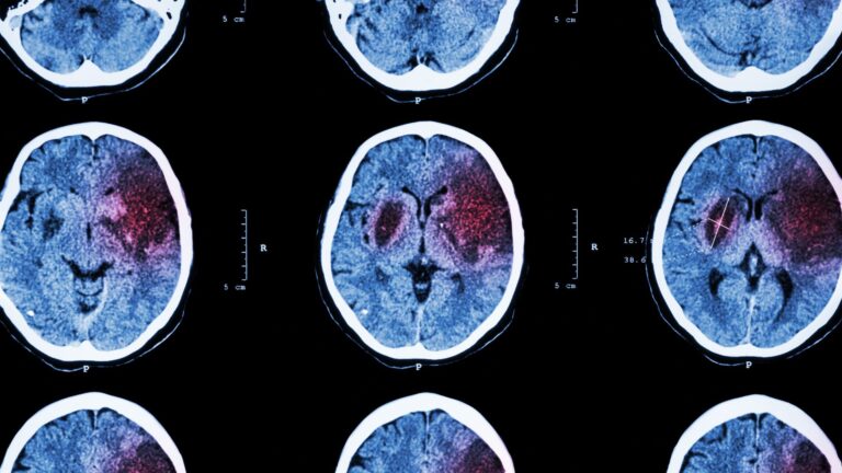 Riabilitazione Post-Ictus: un approccio evidence-based