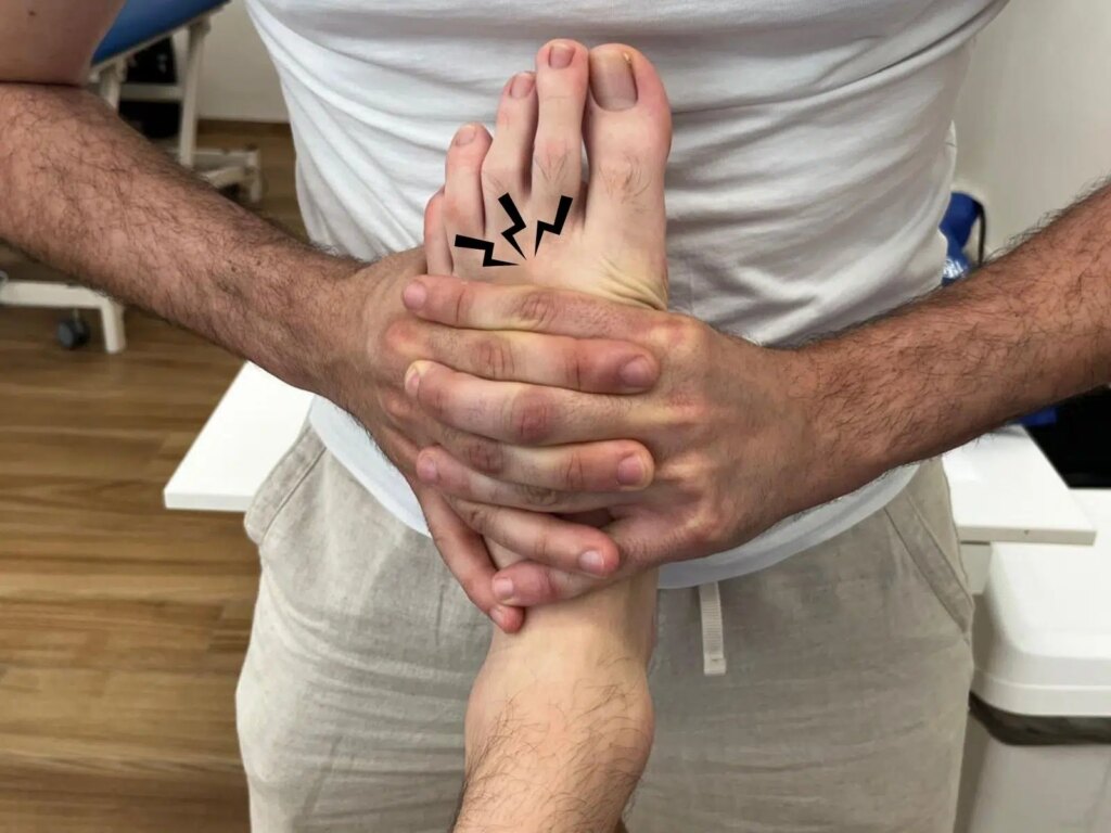 neuroma di Morton: foot squeeze