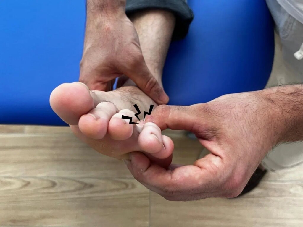 neuroma di Morton: test di Mulder