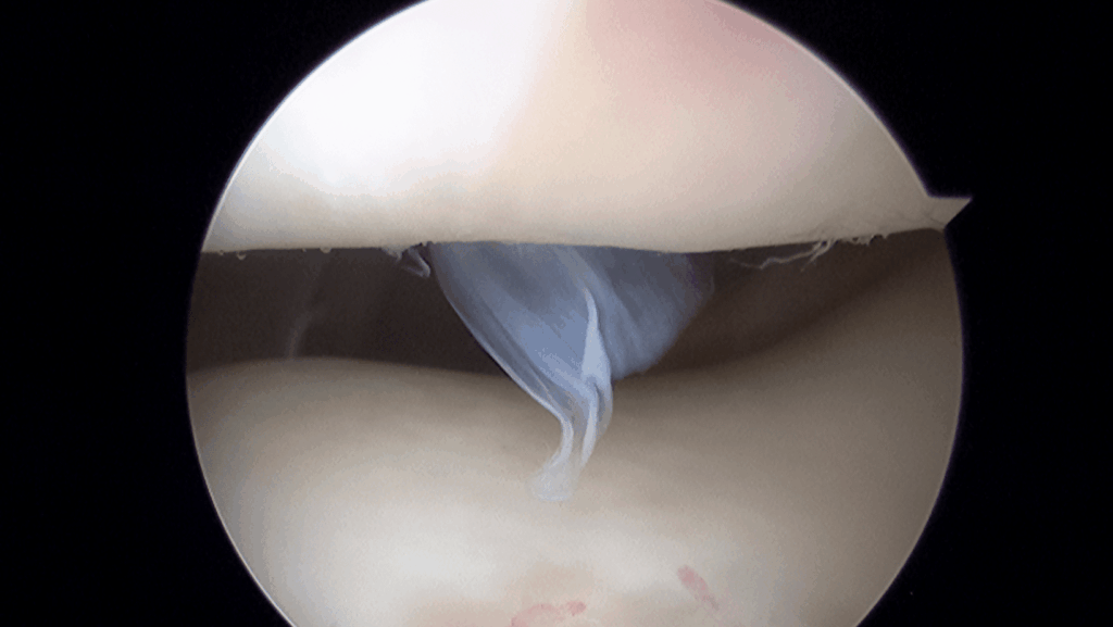 artrosi di ginocchio: cartilagine