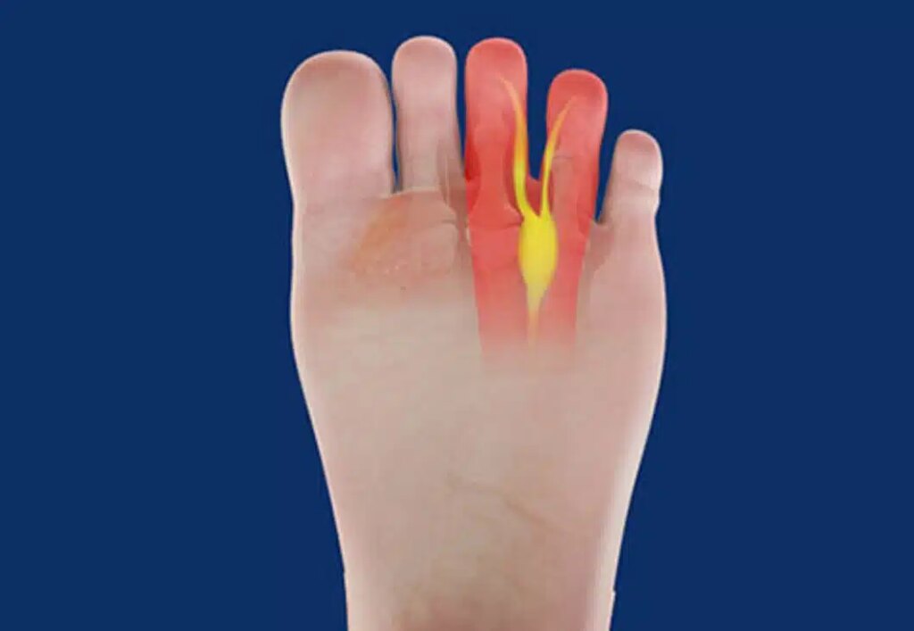 Anatomia neuroma di morton