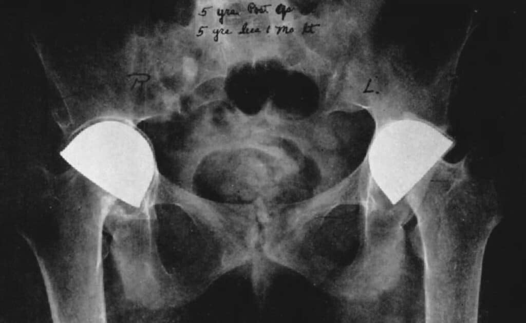 Harris Hip Score: Artroplastica di Smith-Petersen