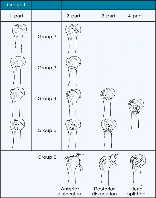 Fratture di Omero: classificazione