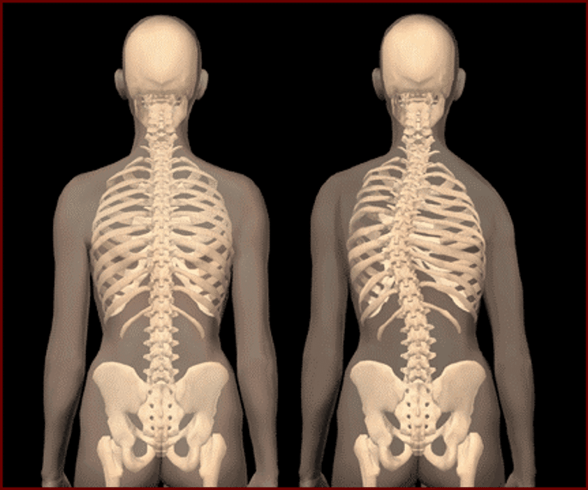 colonna vertebrale scoliosi