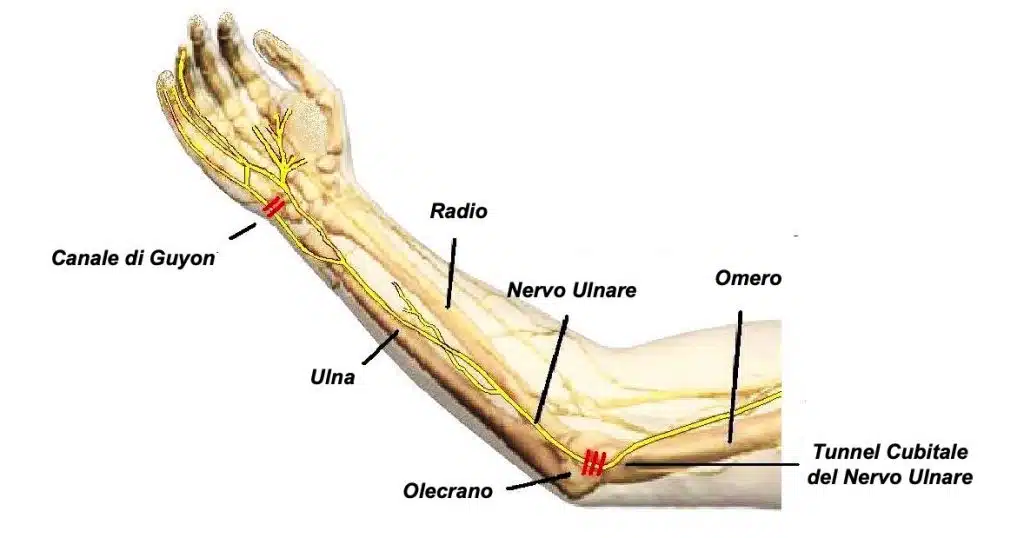 mano benedicente: sito di compressione nervo ulnare