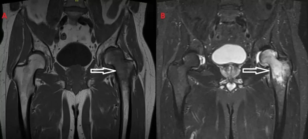 edema osseo radiografia