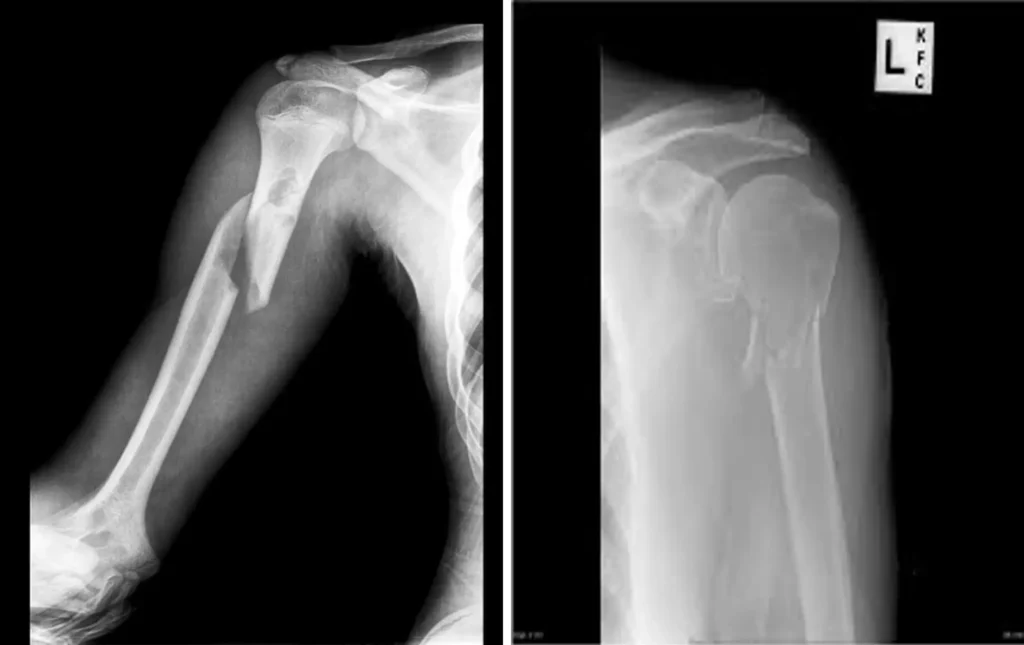 frattura di omero radiografia