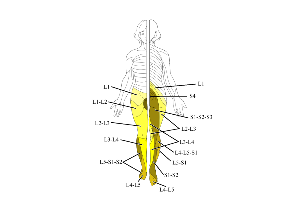 Lombocruralgia: dermatomeri