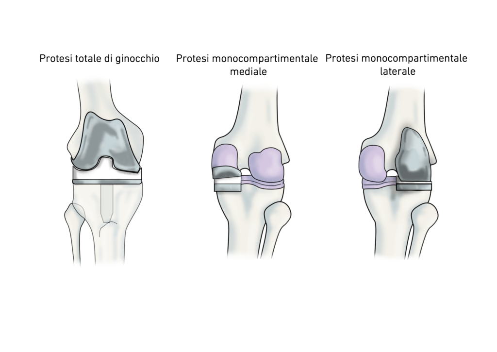 Oxford Knee Score: protesi ginocchio
