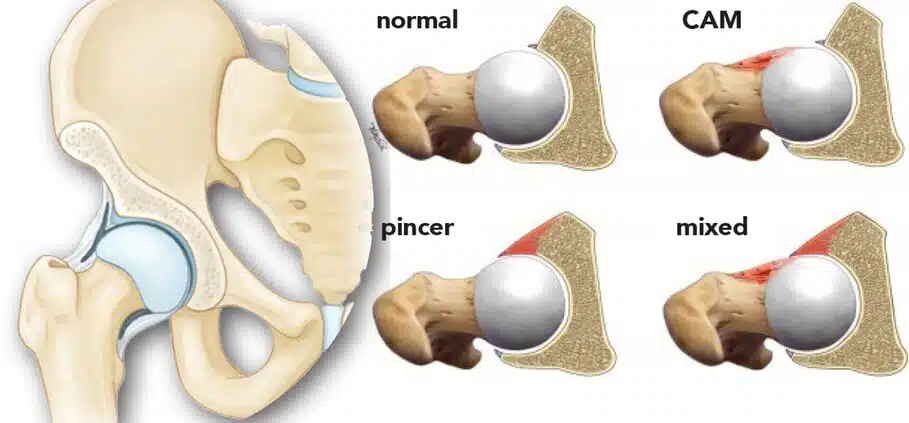 impingement femoro-acetabolare