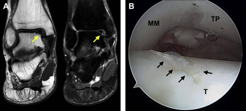 Lesione osteocondrale astragalo: RM