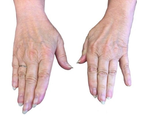 Mano benedicente: segno di Wartenberg