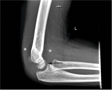 Sindrome di Panner: rx