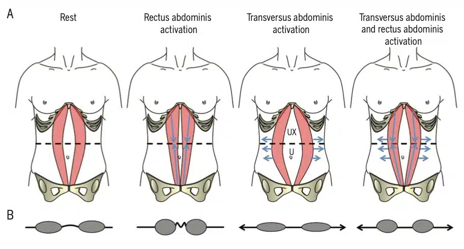 trattamento diastasi addominale