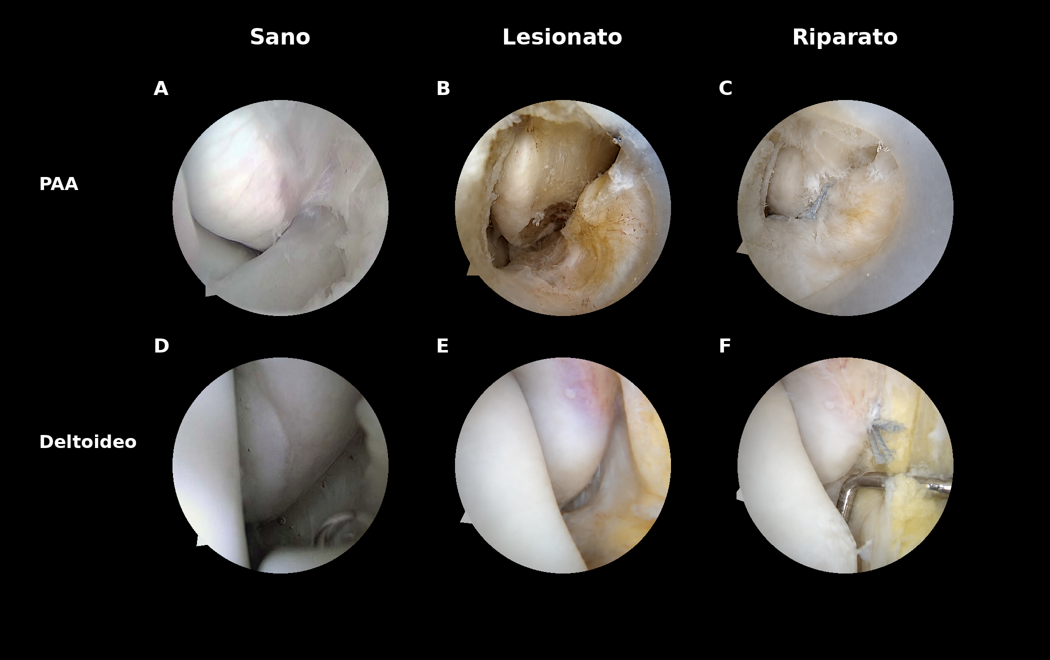 Immagini artroscopiche della caviglia: comparto laterale con legamento peroneo-astragalico anteriore integro, lesionato e riparato; comparto mediale con legamento deltoideo integro, lesionato e riparato.
