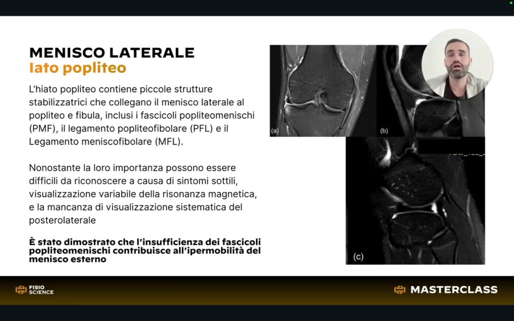 Screenshot lezione - Masterclass Lesioni Meniscali