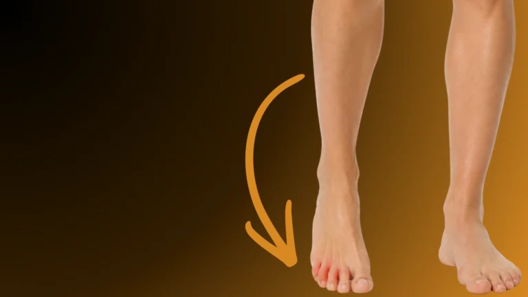 Neuroma di Morton