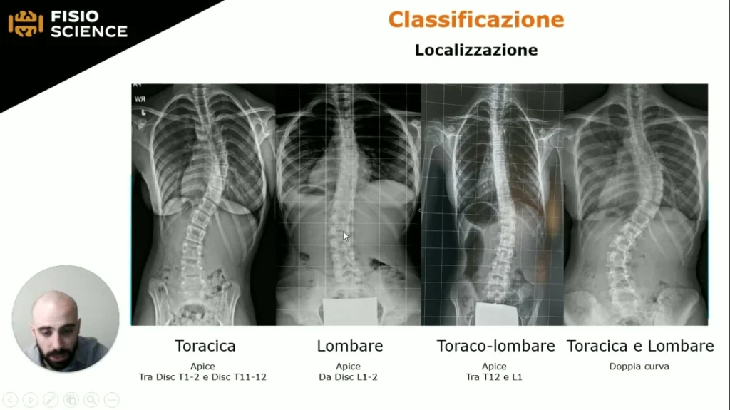 masterclass-scoliosi-lesson-01-1