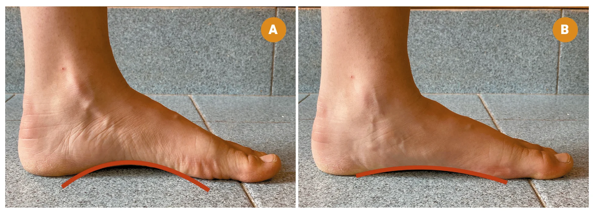 Foot Posture Index item 5, arco appiattito e arco moderatamente alto